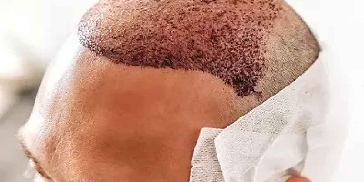 Introduction to Long-Term Hair Solutions