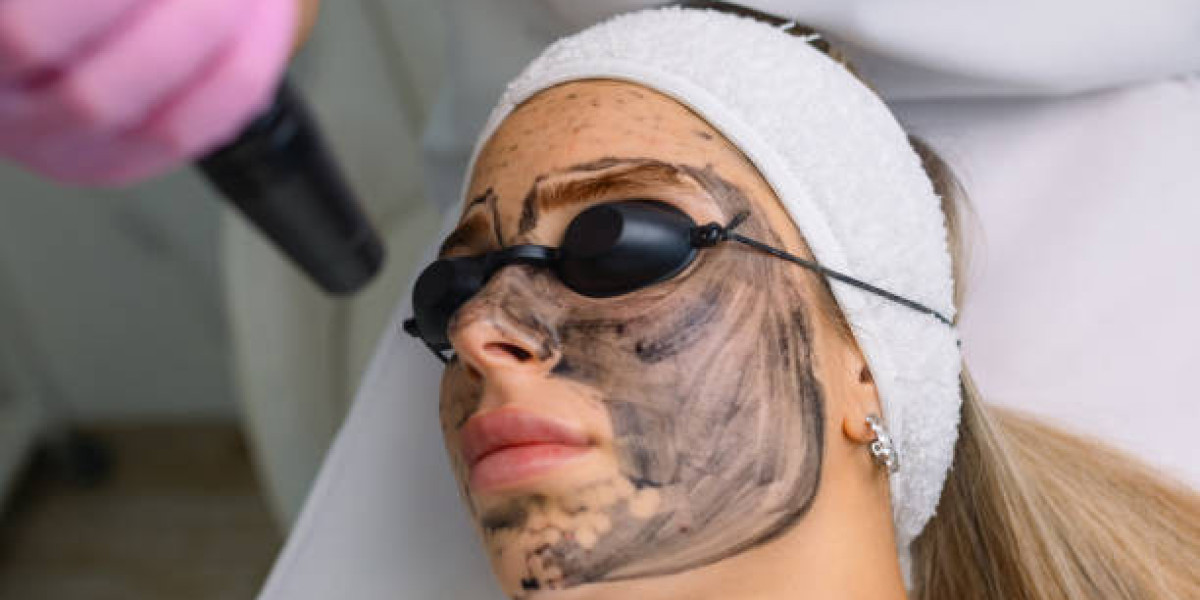 Is carbon laser peeling better than chemical peels?