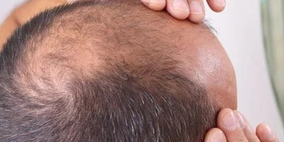 Hair Loss Treatment in Islamabad for Thick Hair