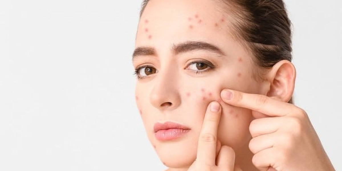Pimple Treatment in Islamabad for Men